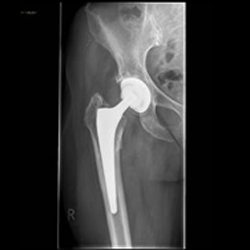 Prothese Röntgenbild