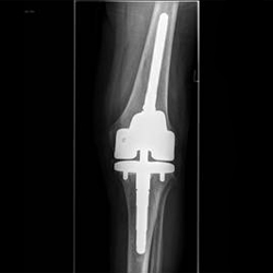 Knieprothese Röntgenbild